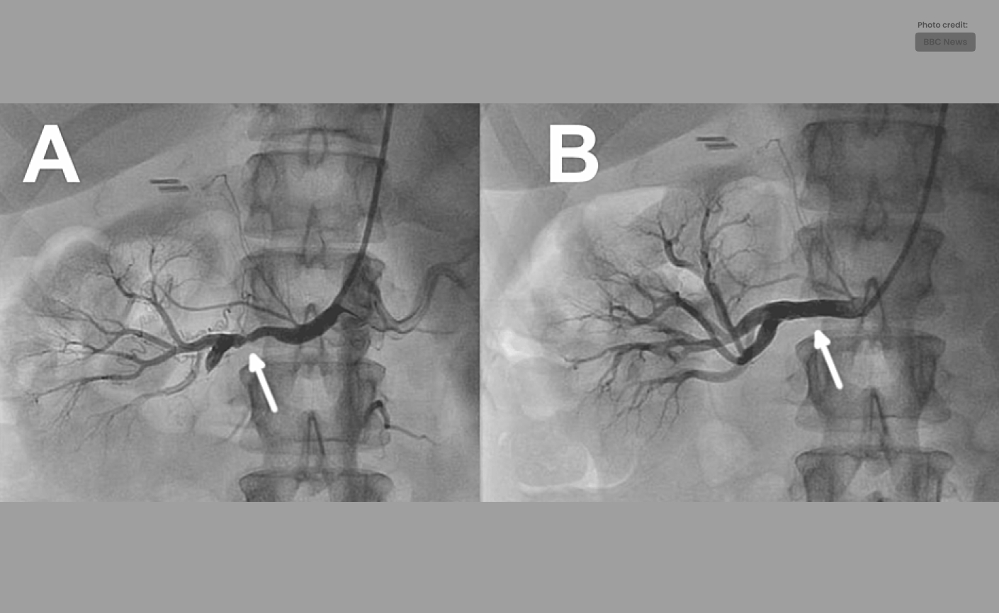 Transradial Renal Angioplasty for Systemic Hypertension