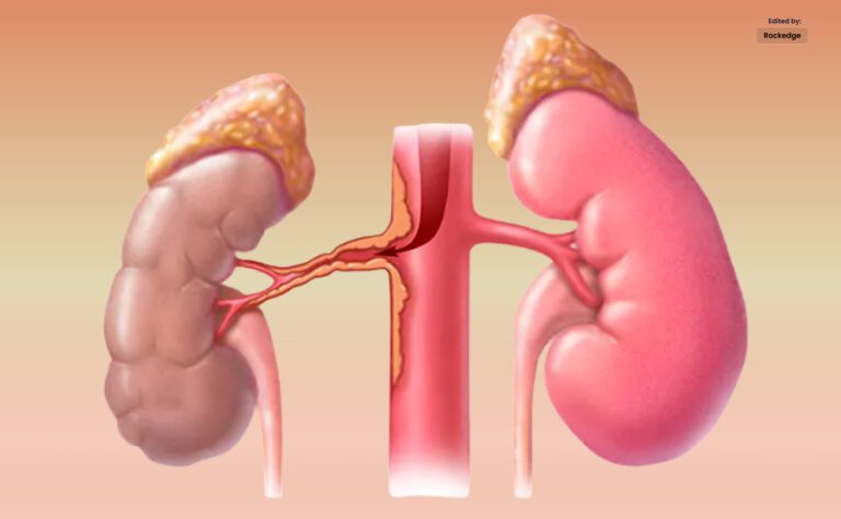 Transradial Renal Angioplasty for Systemic Hypertension