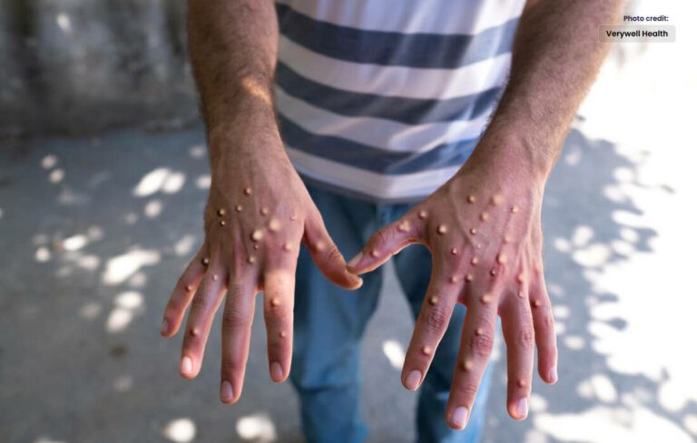 Monkeypox Found in Pakistan, Special Instructions Issued