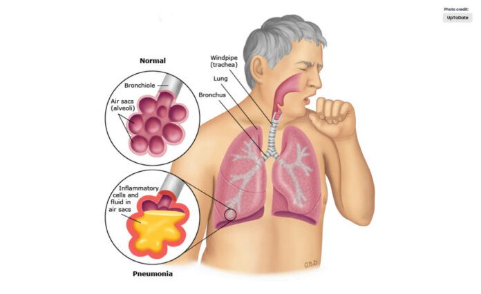 Pneumonia Causes and Treatment