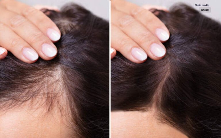 Effective Treatment for Hair Loss: Understanding Your Options