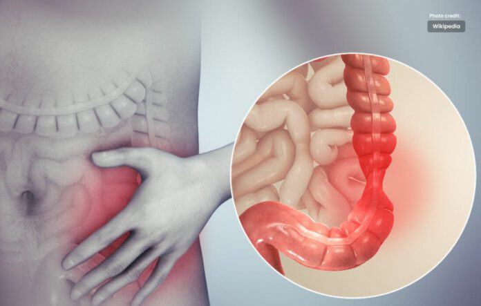 Treatment for IBS: what is it Irritable Bowel Syndrome?