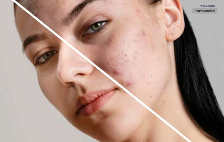 Unmasking the Secrets of Acne Treatment