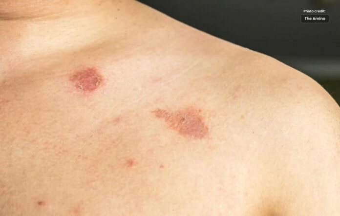 What You Should Know About Ringworm