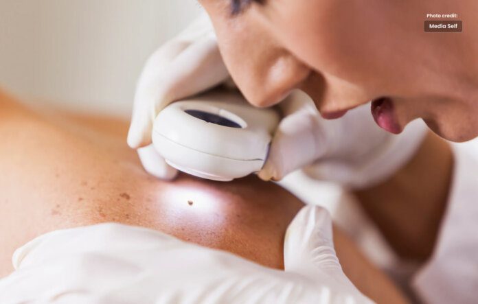 Did You Know About Skin Tag Removal?