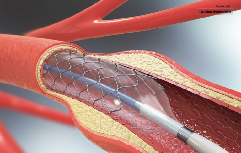 Angioplasty: Restoring Heart Health