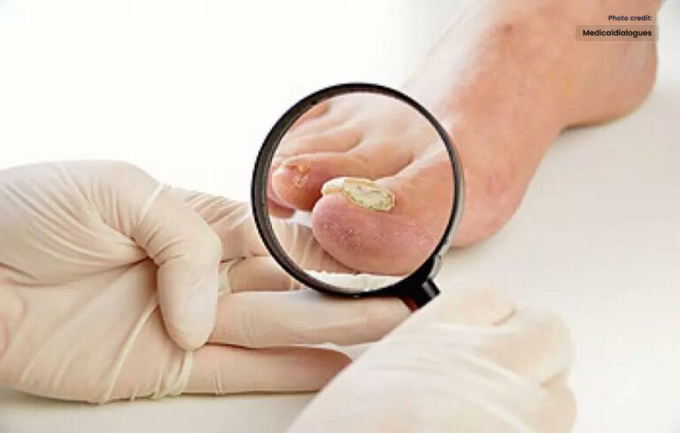 Antifungal Creams A Powerful Solution for Fungal Infections