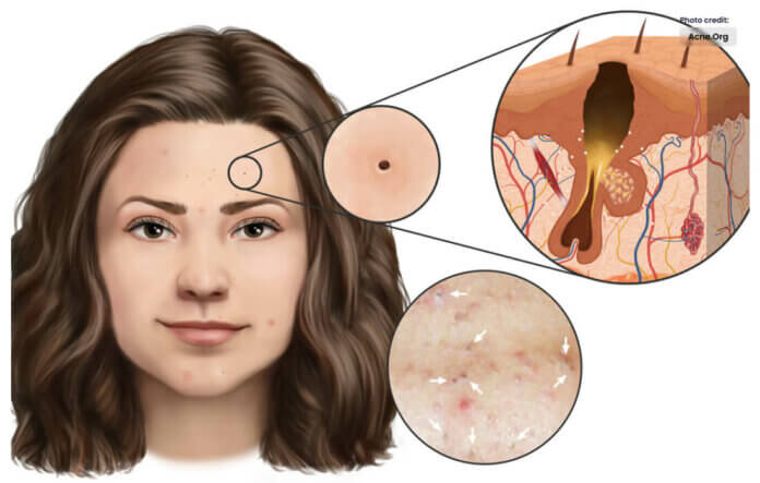 How can get Blackheads Removal Safely?