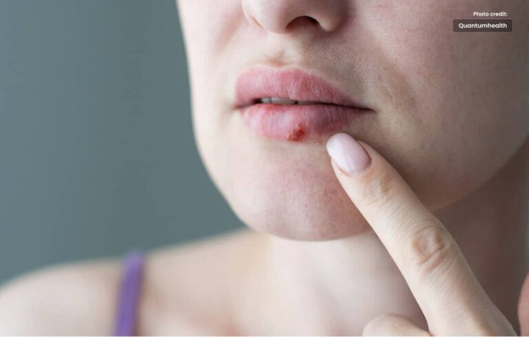 Conquering Cold Sores Effective Treatments and Home Remedies