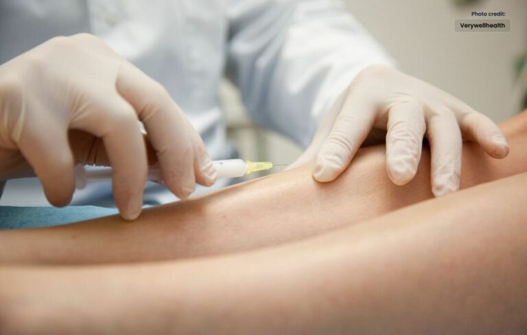 Sclerotherapy: Effective Varicose And Spider Veins Treatment Success