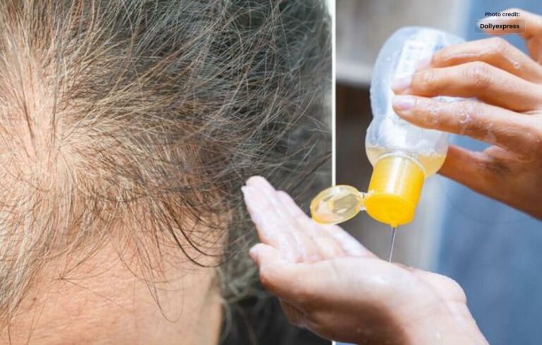 Understanding the Benefits and Uses of Ketoconazole Shampoo