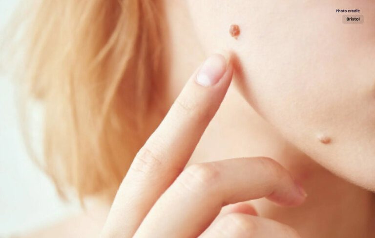 What you Expect After Mole Removal and How it’s Done?