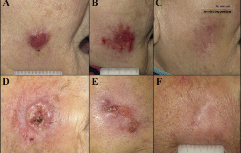 Imiquimod: Harnessing a Topical Wonder for Skin Health