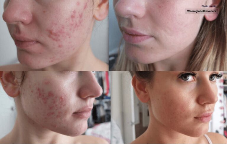 Roaccutane: A Deep Dive into Acne Treatment and Considerations