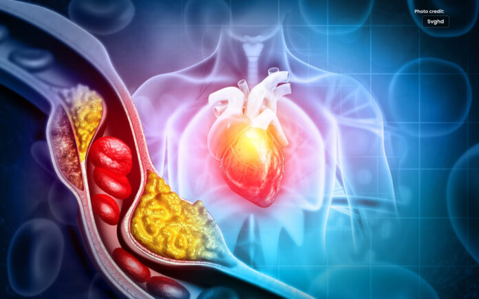 Can High Cholesterol Cause Blood Clots_