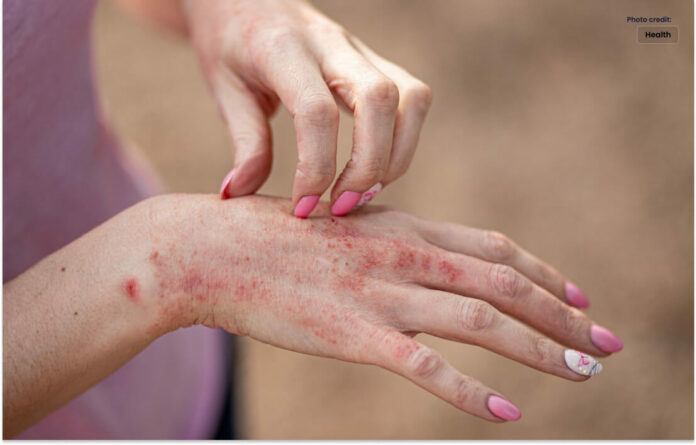 Causes and Symptoms of Skin Allergies