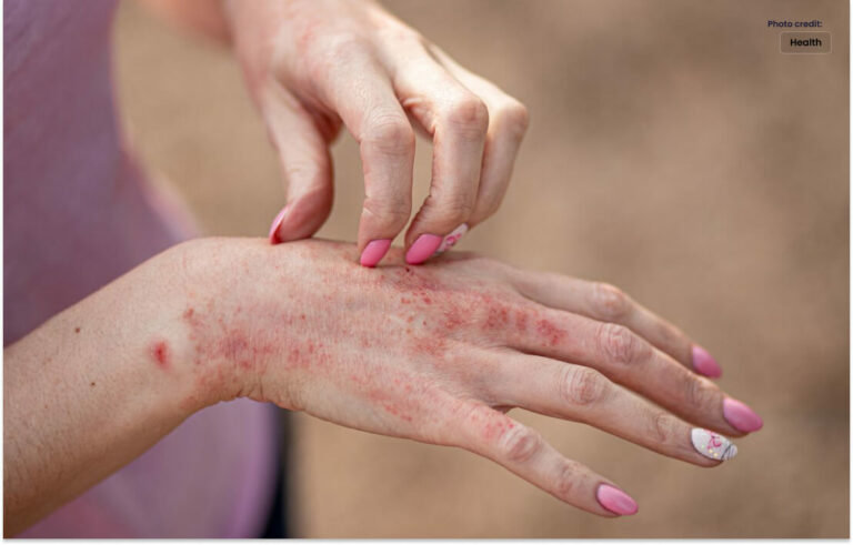 Causes and Symptoms of Skin Allergies