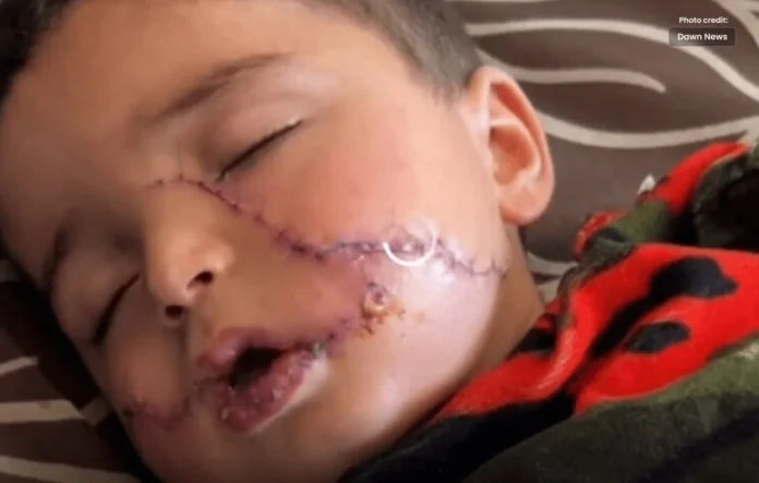 Small Child Injured in Israeli Attack, 200 Stitches on his Face